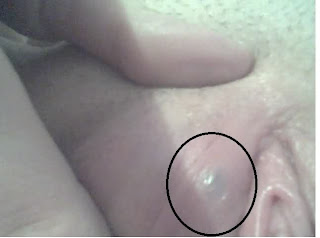 bump on vaginal, bump vaginal, bumps vaginal, bumps on vaginal, vaginal bumps, lump vaginal, lump in vaginal, vaginal lump