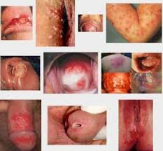 sipilis obat sipilis manjur