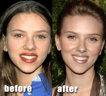 Celebrity Rhinoplasty