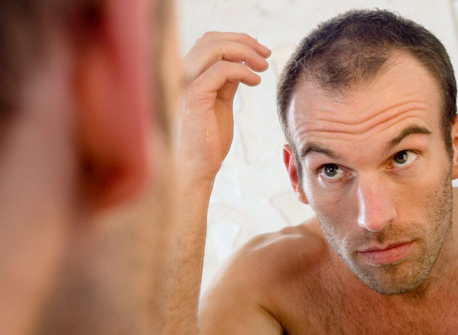 Goldman 75 Percent Of Men Will Experience Baldness At 35 Years Old