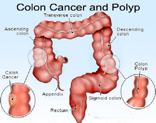 Incidence of colorectal cancer increasing in young adults