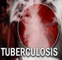 penyakit tbc