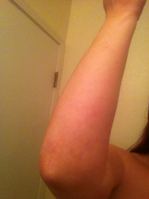 Humira Psoriasis