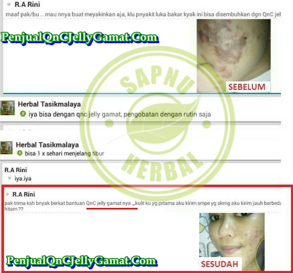 Cara Menyembuhkan Dermatitis Di Wajah Terampuh , TERBUKTI Mujarab!! Cara Menyembuhkan Dermatitis Di Wajah Terampuh , TERBUKTI Mujarab!!