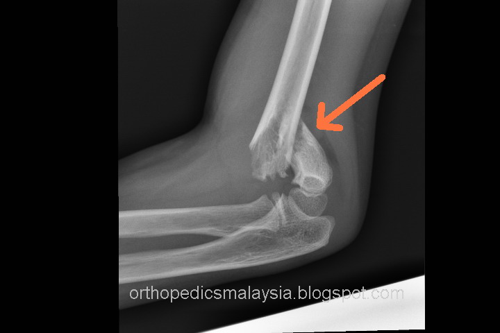 Elbow fractures in Children - Supracondylar fracture of the humerus.