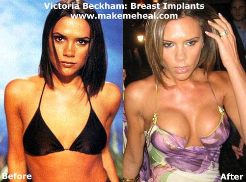 Fake breasts real Breast Forms