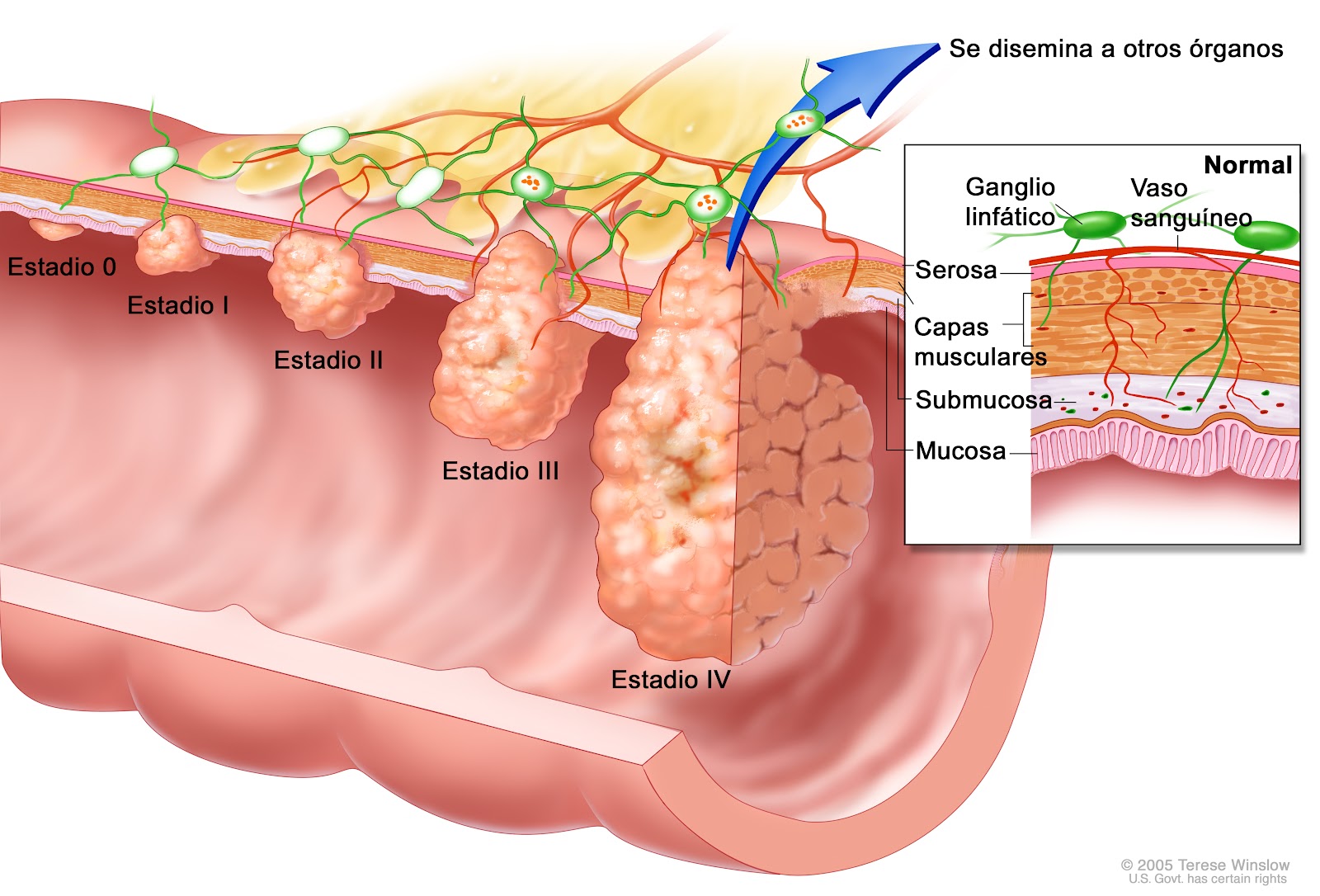 Principal Sitio De Metastasis Del Cancer De Prostata