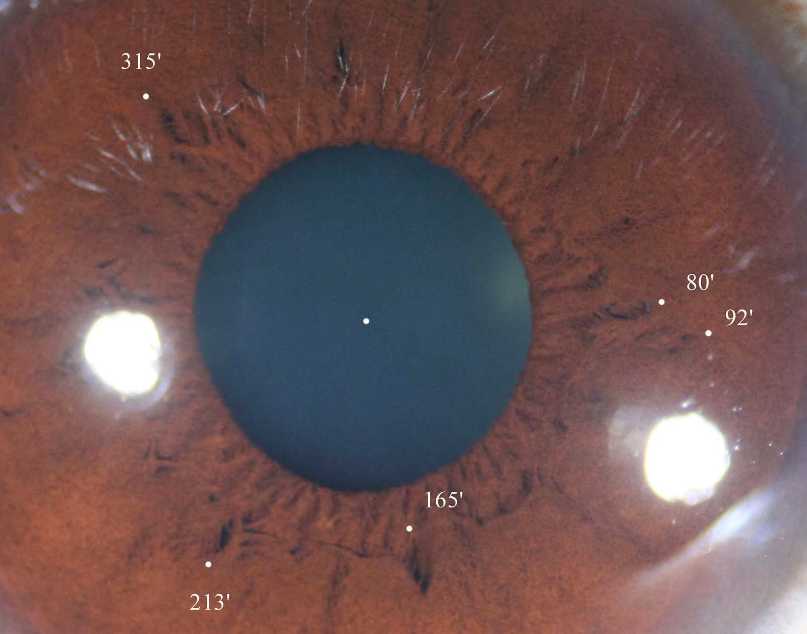 Modern & Multidimensional Iridology Crypts at Pupillary Zone
