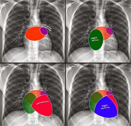 Chest Medicine Made Easy-Dr Deepu: BASICS OF CHEST X RAY-PART 4, THE
