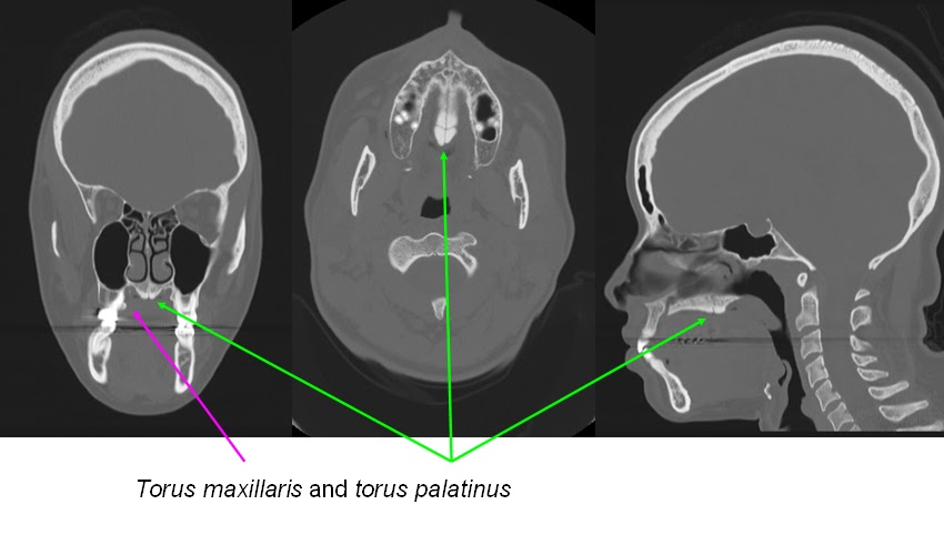 Torus Palatinus Causes
