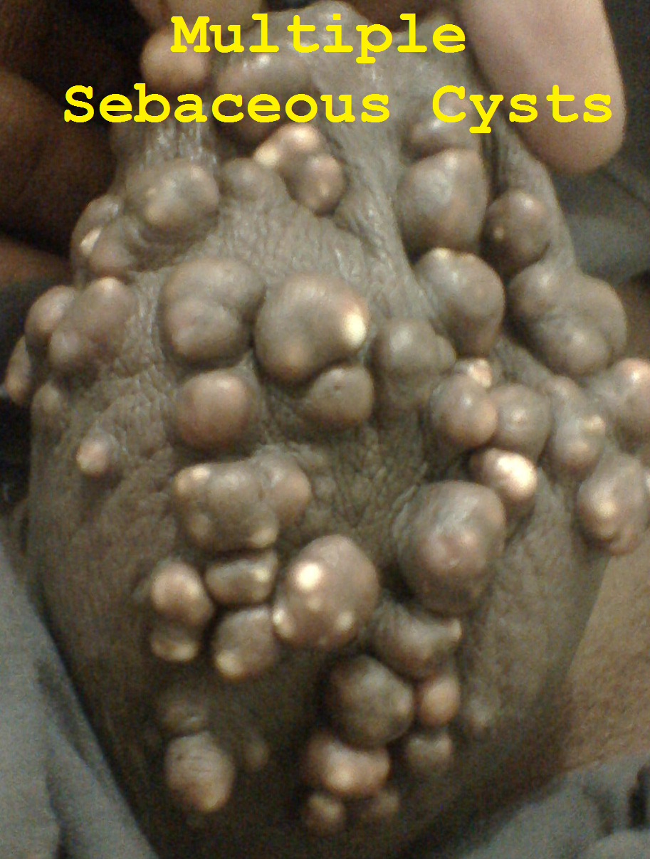 Multiple Sebaceous Cysts  U00ab General Surgical Operations