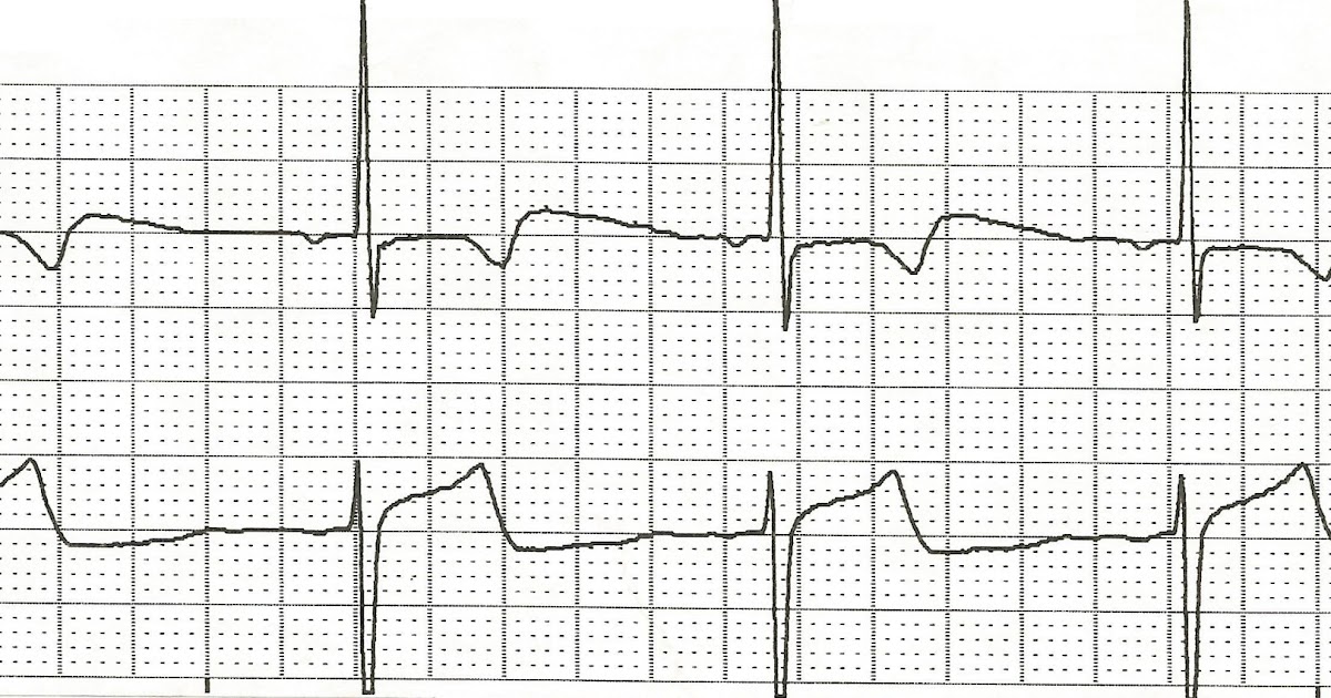 Float Nurse Practice EKG Rhythm Strips 99
