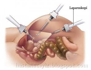 laparoskopi nasıl yapılır