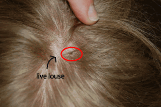 cara menghilangkan kutu rambut cara menghilangkan kutu rambut