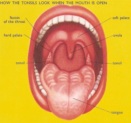 Tonsils+-+Tonsil+Stones.jpg