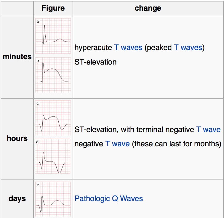 Mill Hill Ave Command New thoughts on posterior MI for EMS