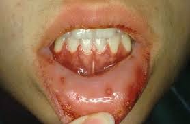 Penyakit Herpes Mulut