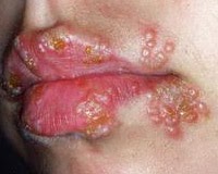 Penyakit Herpes Oral