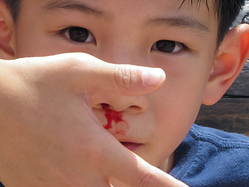 应急巧护理，安全护成长——金惠幼儿园星河分园保育员应急处理之幼儿流鼻血模拟处理展示活动