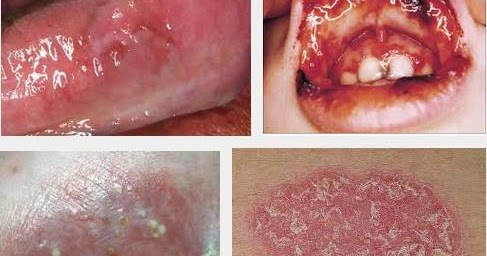 Cara Mengobati Kulit Gatal Kering Dan Berkerak Di Bibir