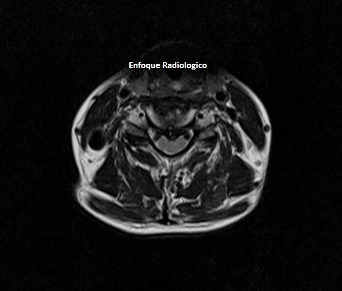 La osteocondrosis del departamento lumbosacro de la columna vertebral la gimnasia médica