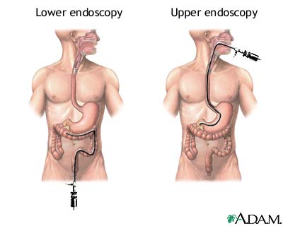 Picture Of Endoscopy