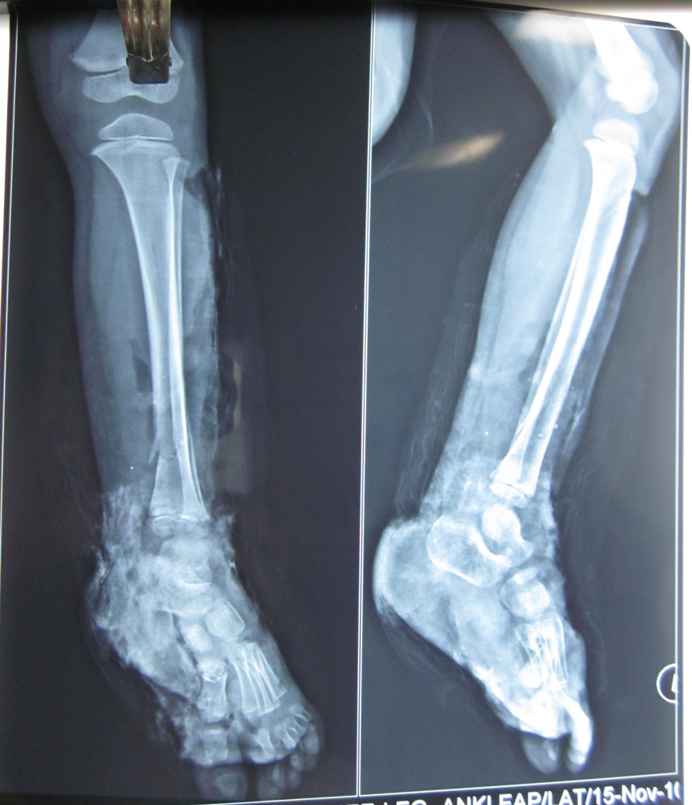 MAJOR CRUSH INJURY LEG AND FOOT FREE TISSUE TRANSFER LOWER LIMB