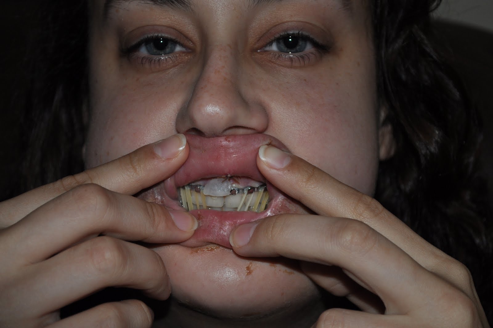 Hilary's Broken Face July 2011