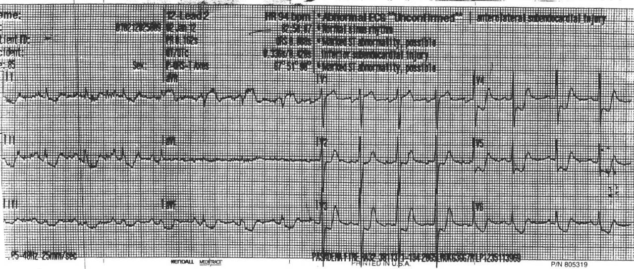 Non Stemi Mi Elevation