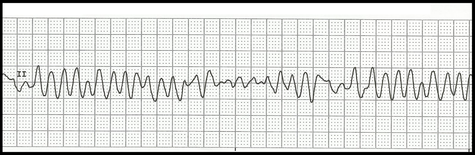 Float Nurse: Basic EKG Rhythm Test 04