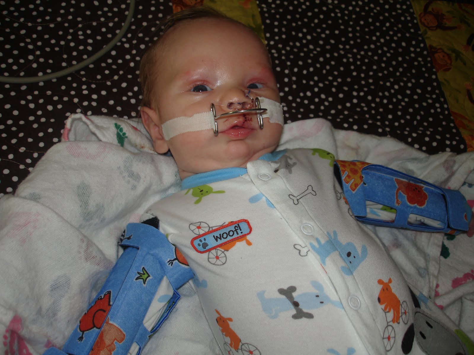 Our Cleft Story Dallin's accessories