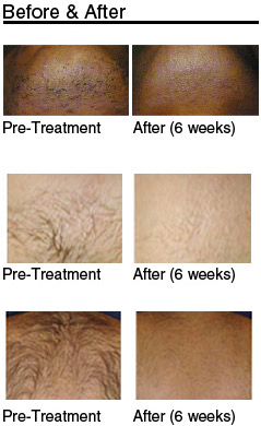 Aspects That Influence The Price Of Laser Hair Removal