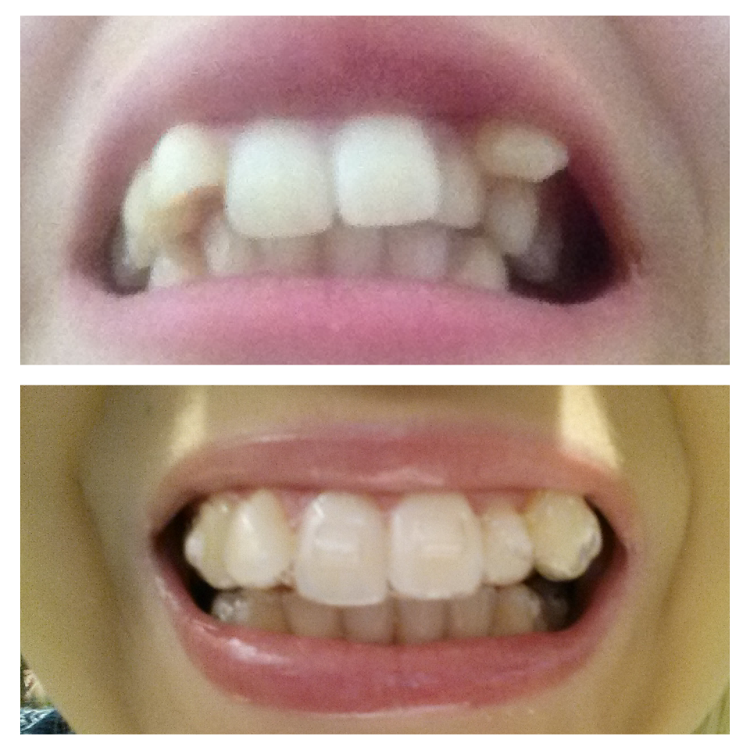 invisalign attachments