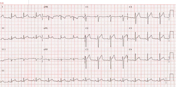 st elevation secondary to ivcd st elevation secondary to ivcd