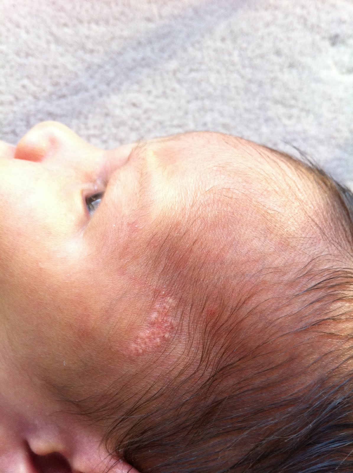 Jadassohn Nevus