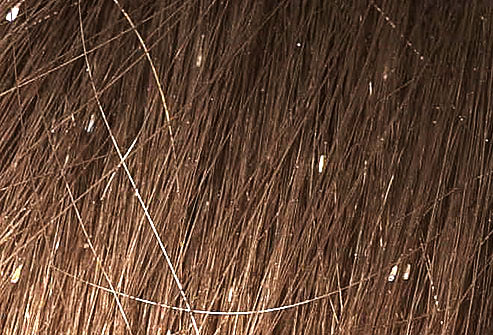 Scalp Lice