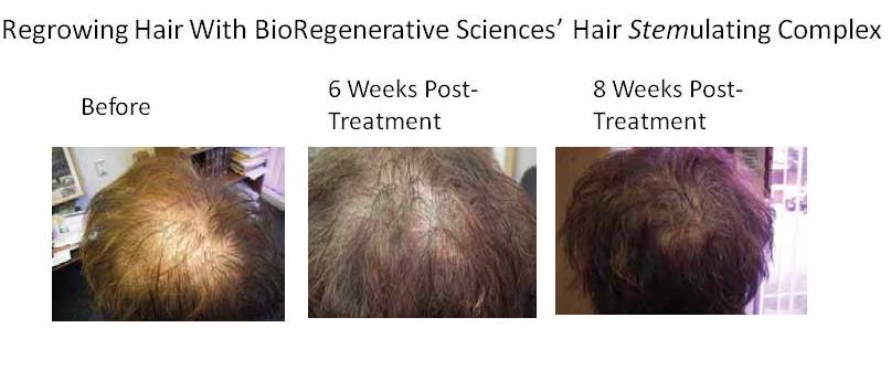 Enhancing Health Beauty And Wellness Hair Regrowth Using Stem