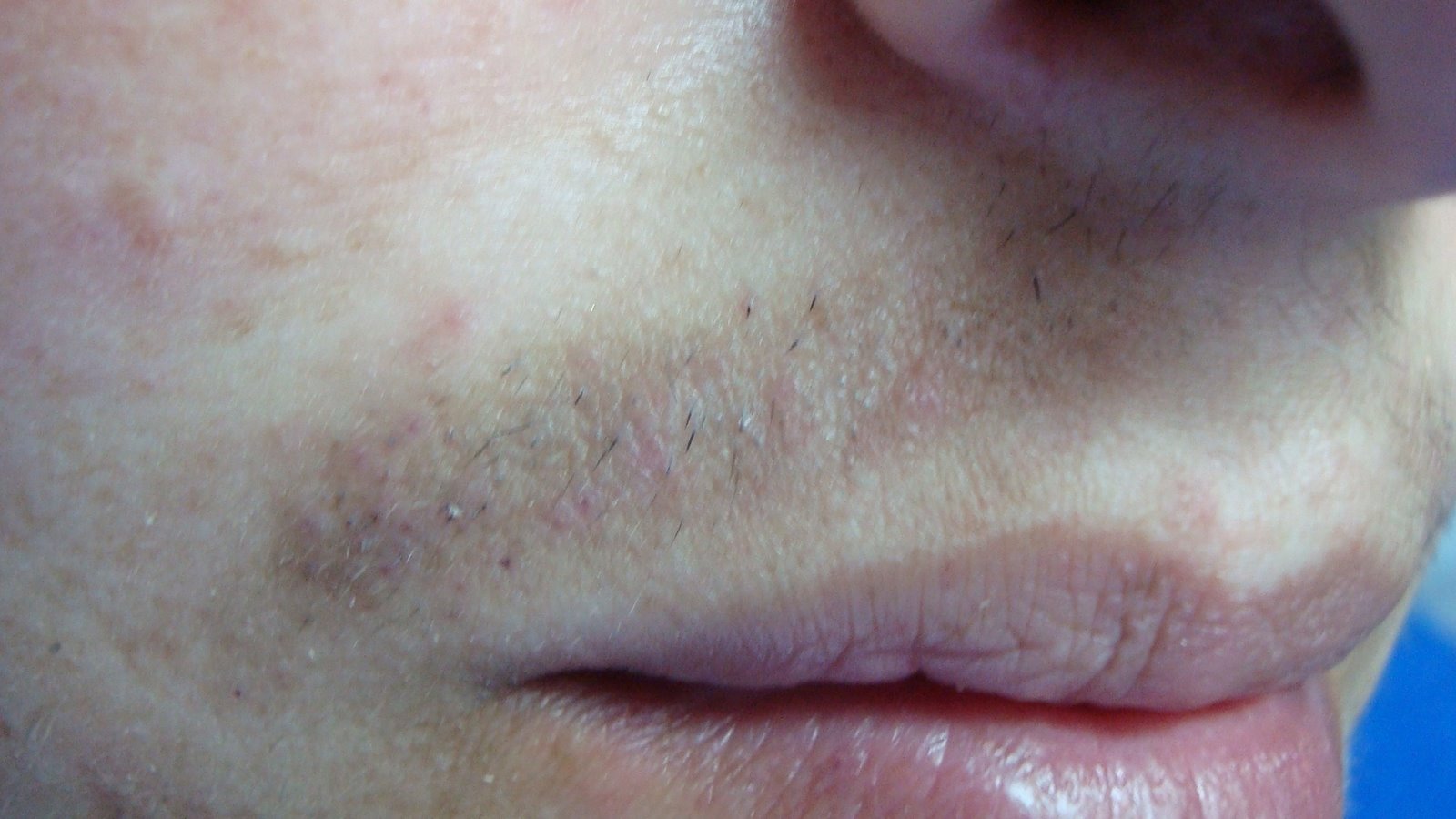 Depilación Eléctrica Definitiva (Electrolysis). Portal de información