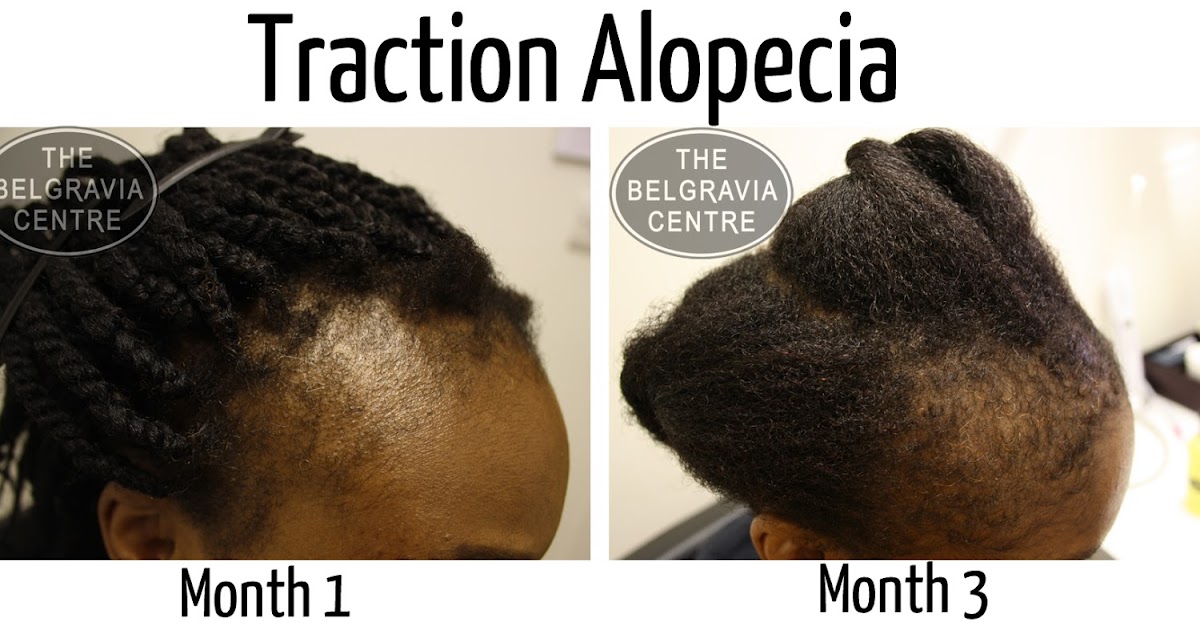 Brown Hair Traction Alopecia How To Regrow Your Hair