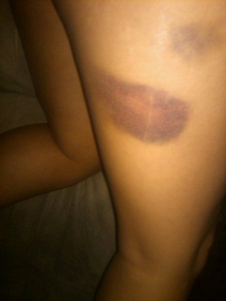 Doa S Bloody Bruise Blog Grrrly Legs