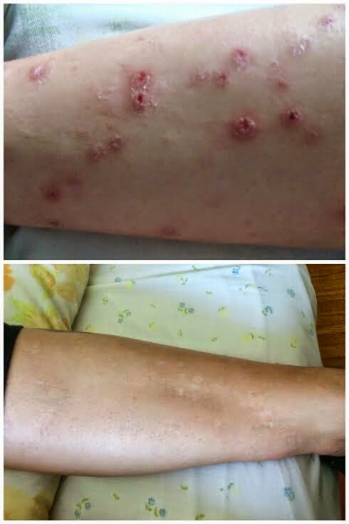 Before and After Treatment Pictures