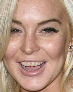 lindsay drug lohan teeth abuse yellow bad ugly dies mca tooth alcohol treatment towards response condition her but who chatter