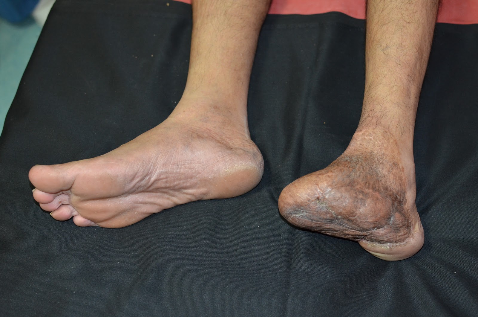 MAJOR CRUSH INJURY FOOT HEEL PAD AVULSION LOWER LIMB INJURY CRUSH