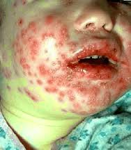 Penyakit Herpes pada bayi