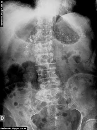 Pancreatitis crónica