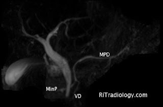 RiT radiology: Pancreatic Divisum