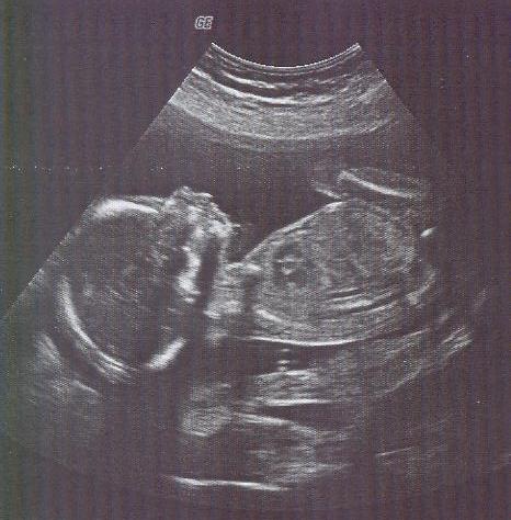 Boy Ultrasound Pics