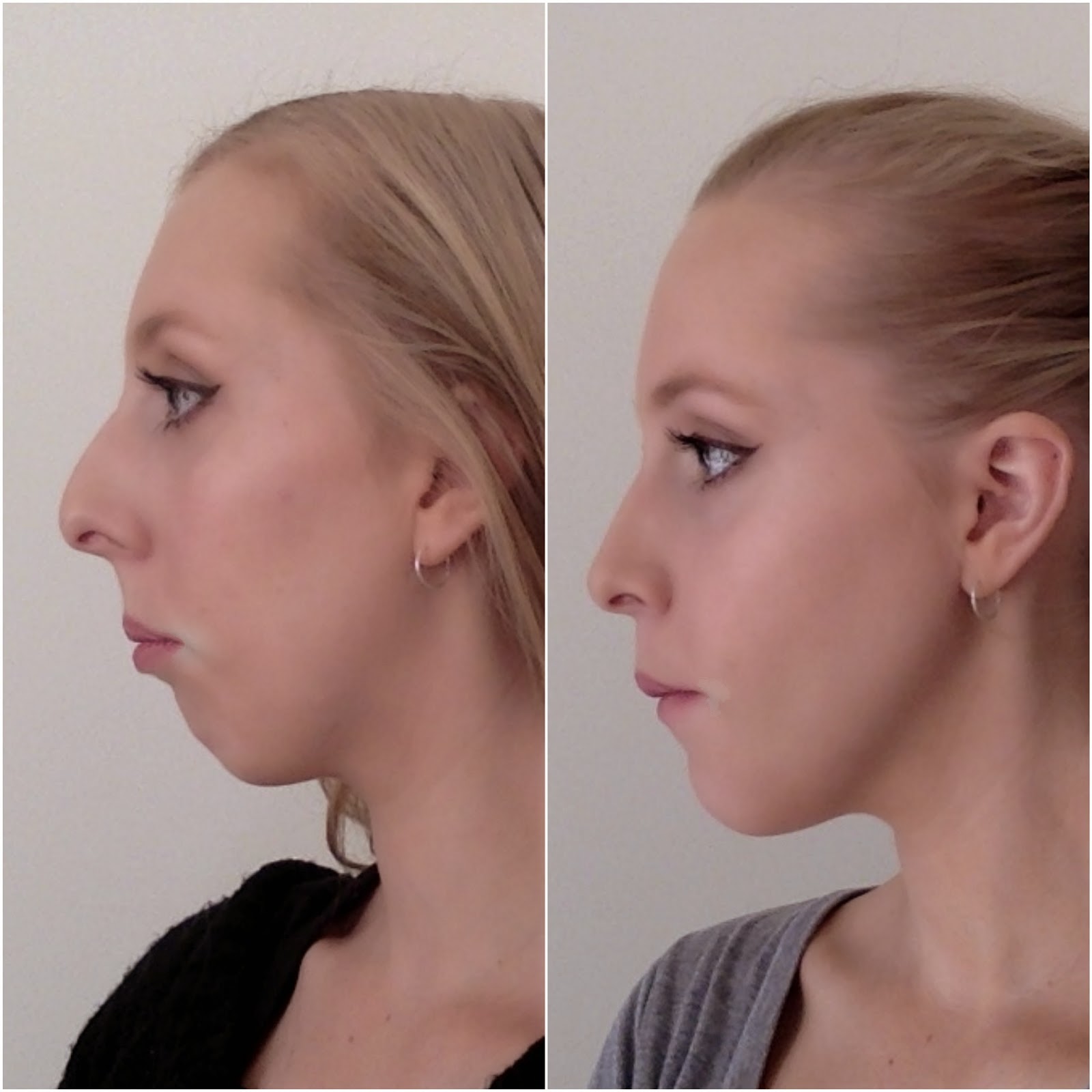 Lama Hasan'S Post Surgery Life: A New Beginning - xj164md