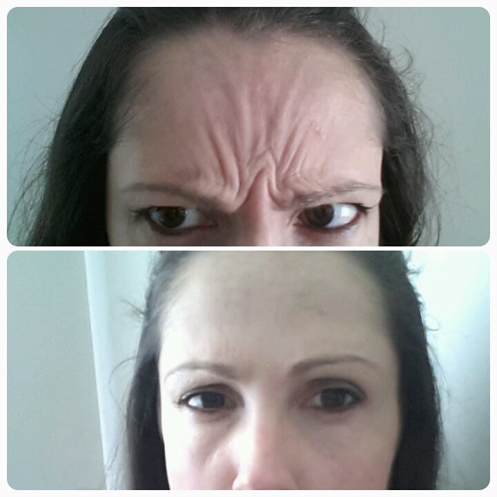 botox.jpg