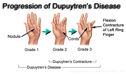 Image result for dupuytren's contracture